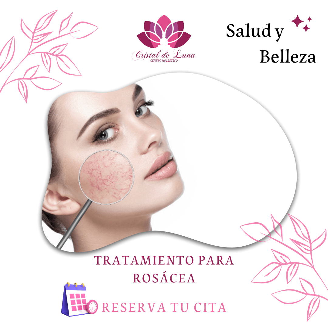 TRATAMIENTO PARA ROSÁCEA