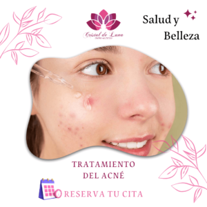 TRATAMIENTO PARA EL ACNÉ